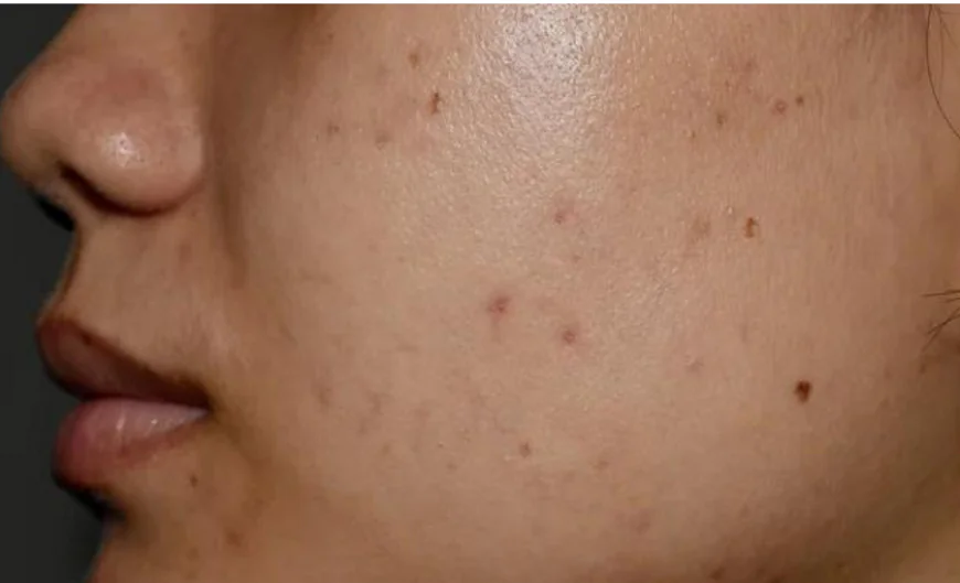 Pigmentation Treatment Dubai: Cost & Clinic Insights