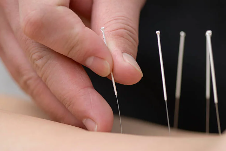 Acupuncture Treatment in Dubai: What to Expect