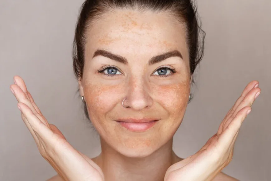 Melasma: Causes, Symptoms, and Treatment Options