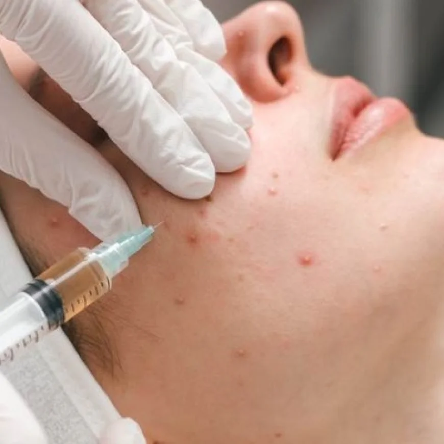 خيارات علاج حب الشباب من قبل أطباء الجلدية