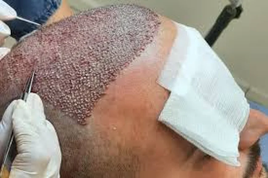 Best Hair Transplant Solutions in Dubai