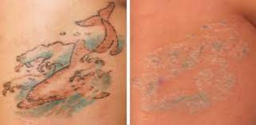 Affordable Laser Tattoo Removal Dubai Clinics Revealed