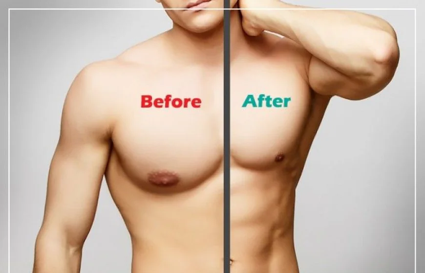 Gynaecomastia Surgery in Dubai: Revision Surgery – When and What to Expect