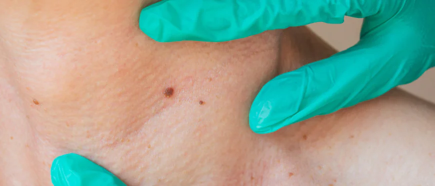 Where Do Skin Tags Most Frequently Develop on the Body?