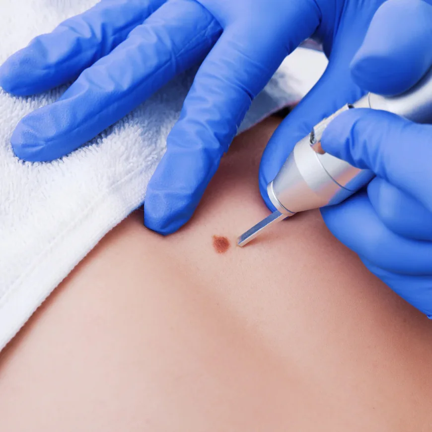 Skin Tag Removal in Dubai