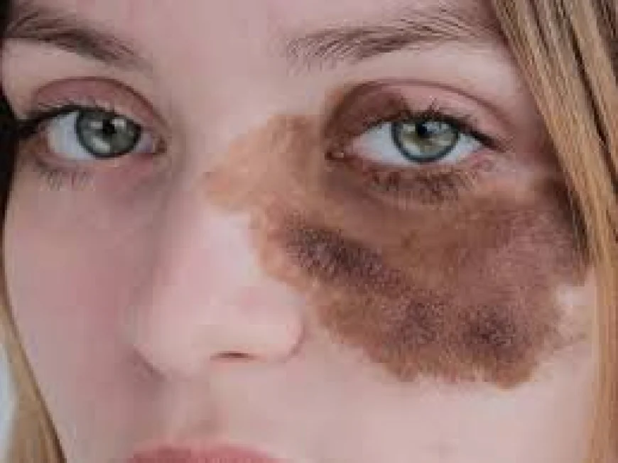 Laser Birthmark Removal Specialists in Dubai