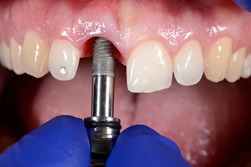 Why Dental Implants Are the Gold Standard for Tooth Replacement in Islamabad