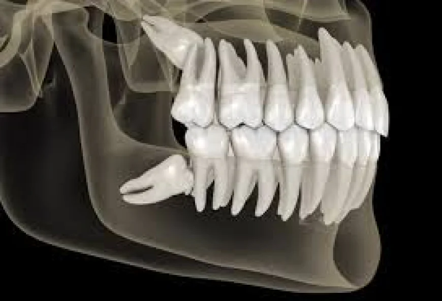 Effective Wisdom Teeth Pain Relief Methods You Can Try