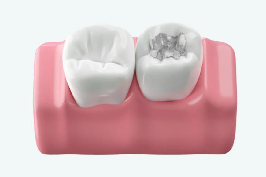 A Smart Solution for Cavity-Free Teeth Dental Fillings in Islamabad: