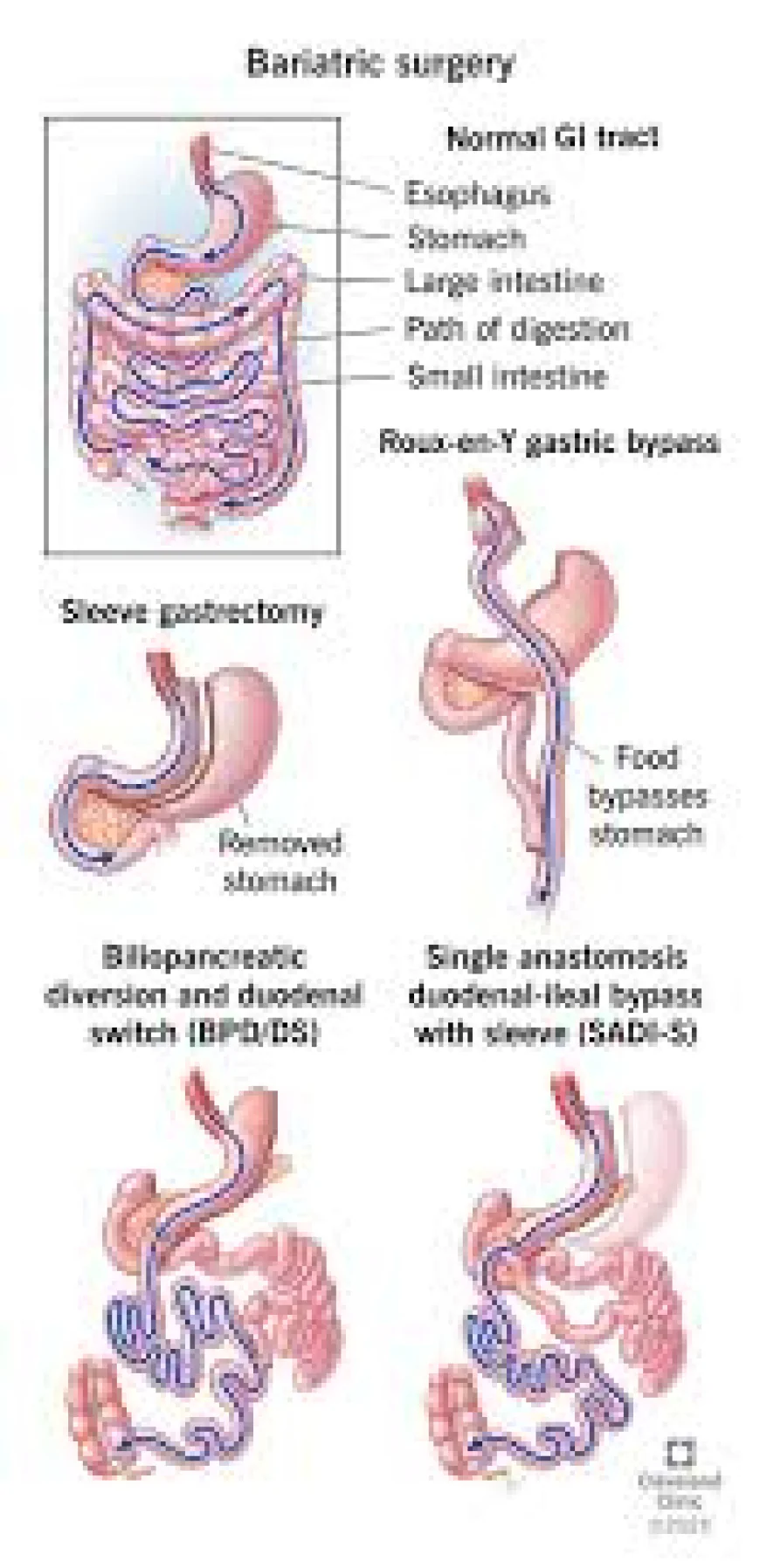 Bariatric Surgery 2026: Your Complete Guide to Safe and Effective Weight Loss