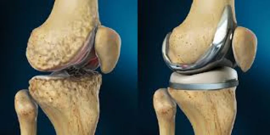 What Parts of the Knee Are Replaced During TKR?