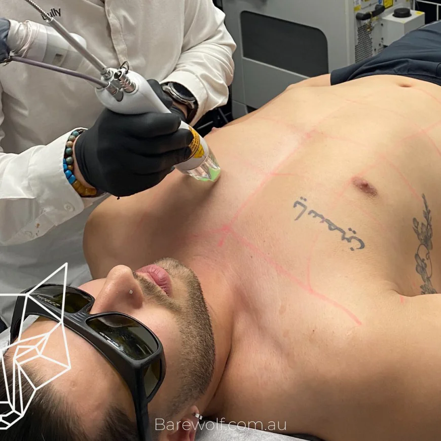 Why More Men Are Choosing Male Hair Removal in Sydney