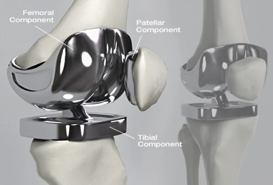 What Materials Are Used in Artificial Knee Joints?