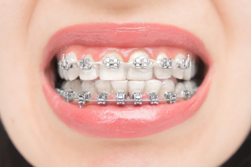 Clear Braces in Houston: Transform Your Smile with the Best Orthodontist in Houston
