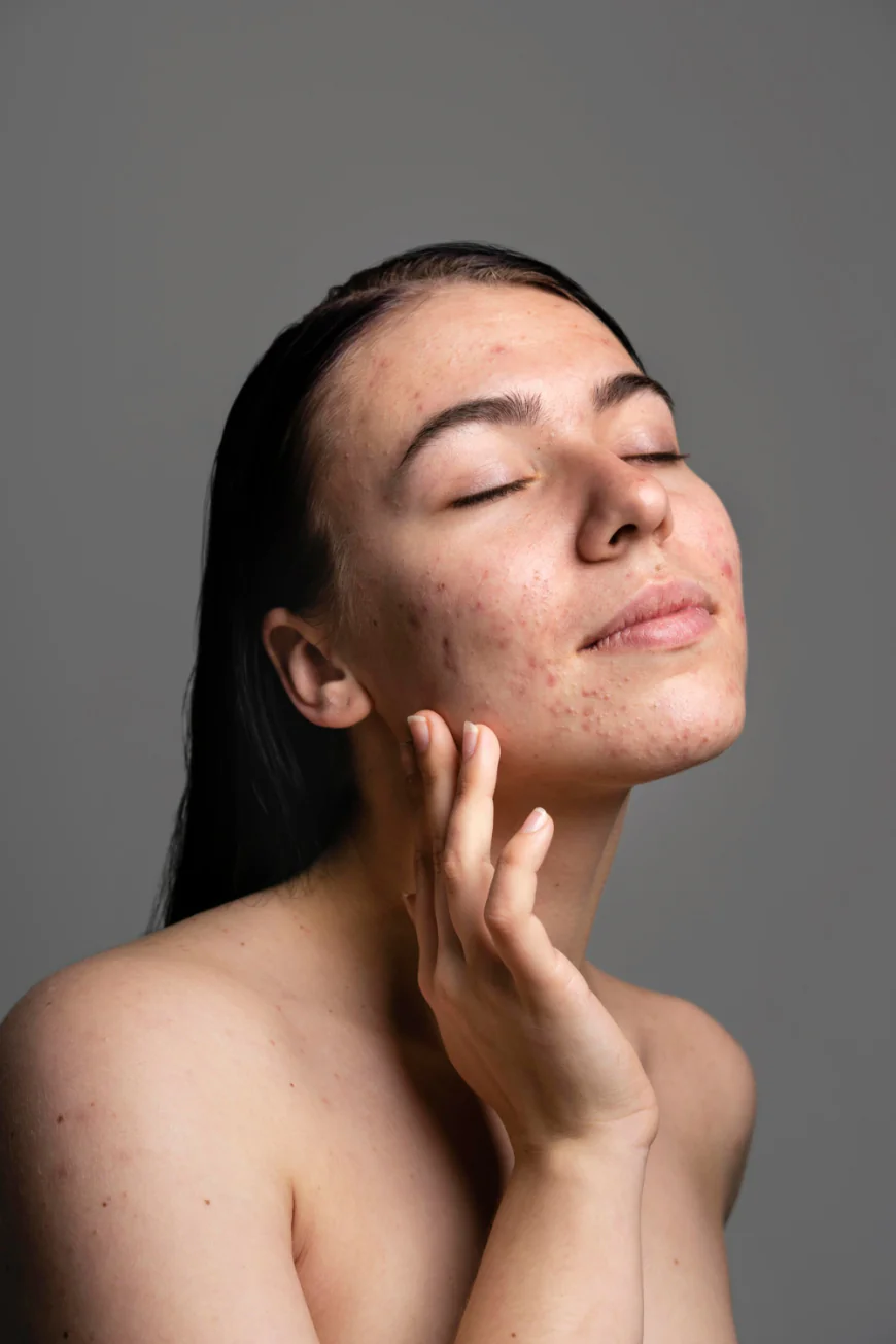 Acne: Causes, Types & Modern Treatment Options