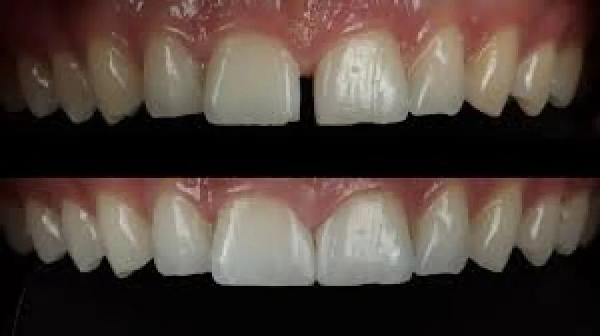 Transform Your Smile with Modern Dental Bonding Care