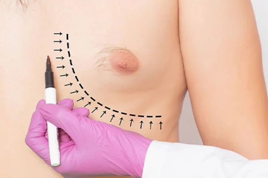 What Is the Procedure of Gynecomastia Surgery?