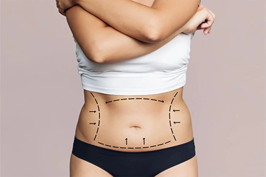 What Is the Procedure of Tummy Tuck Surgery?