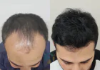 Restore Confidence with Hair Transplant in Islamabad