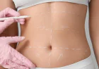 شد البطن ونحت الجسم التجميلي