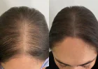 PRP Hair Treatment in Dubai: The Clinical Guide to Results