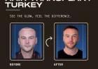Hair Transplant Turkey: Safe and Advanced Solutions for Hair Restoration
