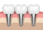 Transform Your Smile with Confidence: Expert Dental Implants & Braces in Houston