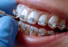 dental braces in islamabad