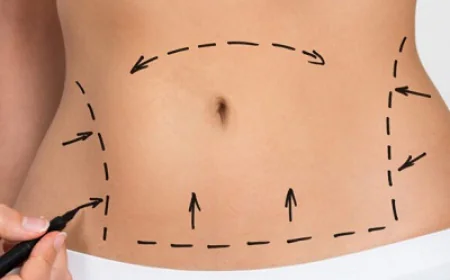 شد البطن لعلاج ترهل الجلد في منطقة البطن