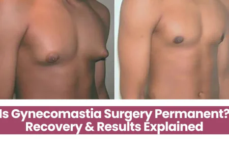 Is Gynecomastia Surgery Permanent? Recovery & Results Explained