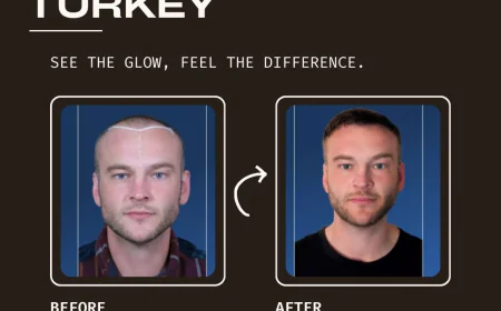 Hair Transplant Turkey: Safe and Advanced Solutions for Hair Restoration