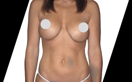 What Is Breast Implant Revision Surgery in Houston?