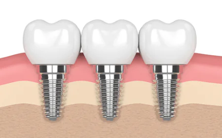 Transform Your Smile with Confidence: Expert Dental Implants & Braces in Houston