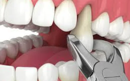 What Is Tooth Removal and When Is It Needed?