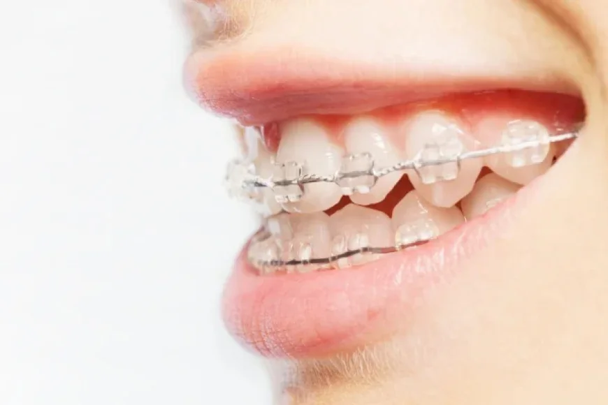 Straighten Smiles the Smart Way – Clear Aligners & Invisible Braces for Teens in League City!