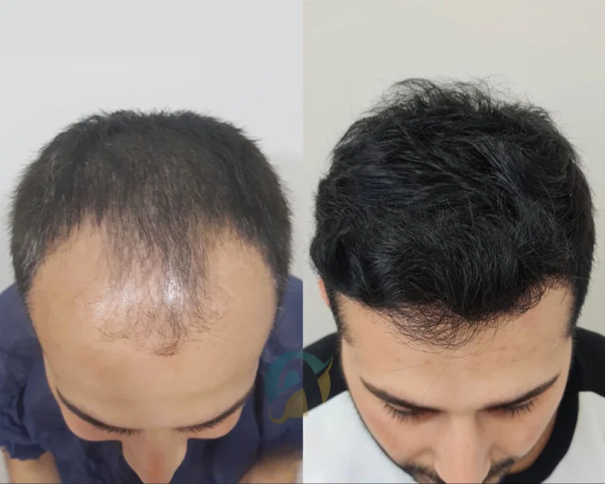 Restore Confidence with Hair Transplant in Islamabad
