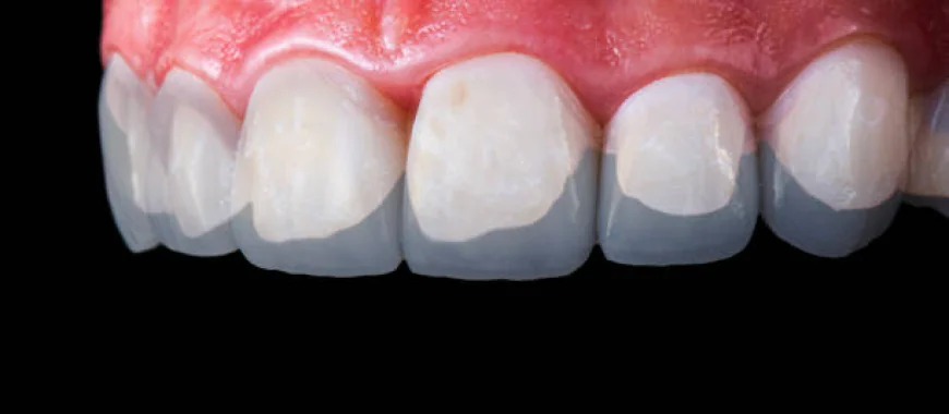 The Ultimate Smile Enhancement Solution You Should Know About