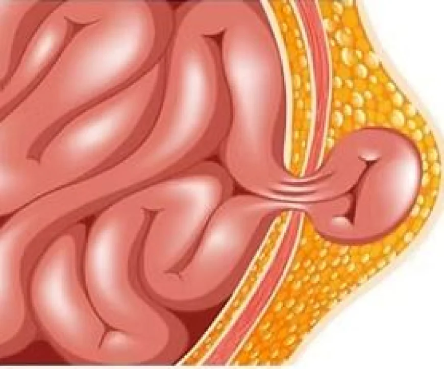 Expert Hernia Surgery Singapore — Modern Solutions for Faster Recovery