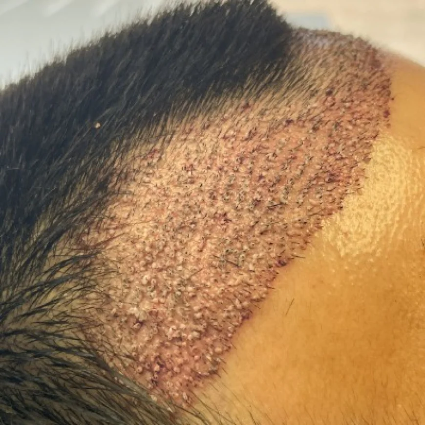 Restore Your Hair and Confidence with Hair Transplant in Islamabad