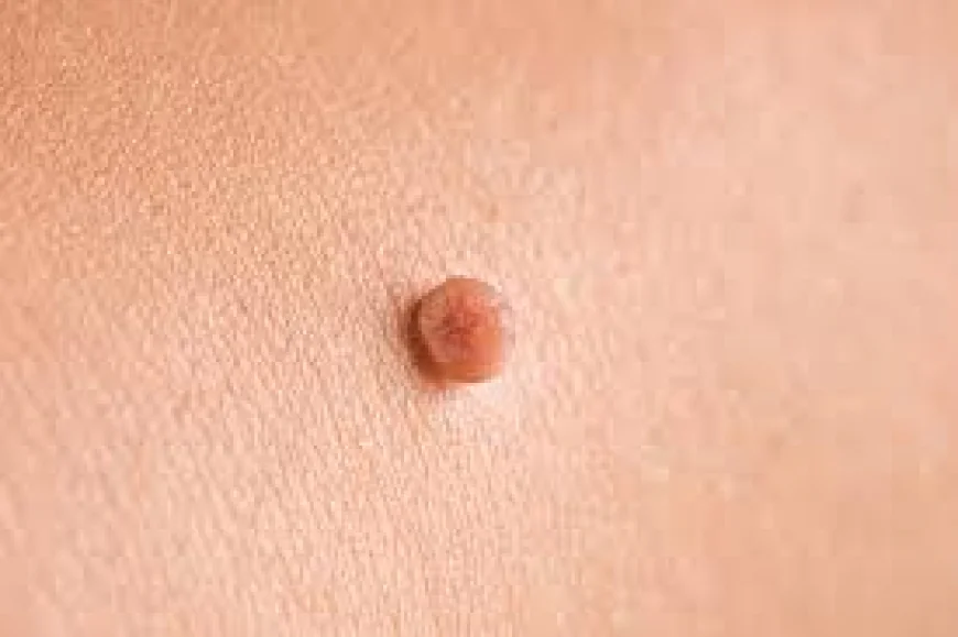 Is Skin Tag Removal Suitable for All Skin Types?