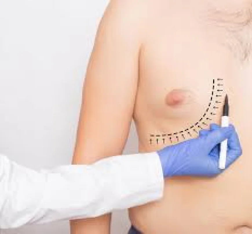 Gynaecomastia Dubai: Assessing Long-Term Outcomes and Permanence