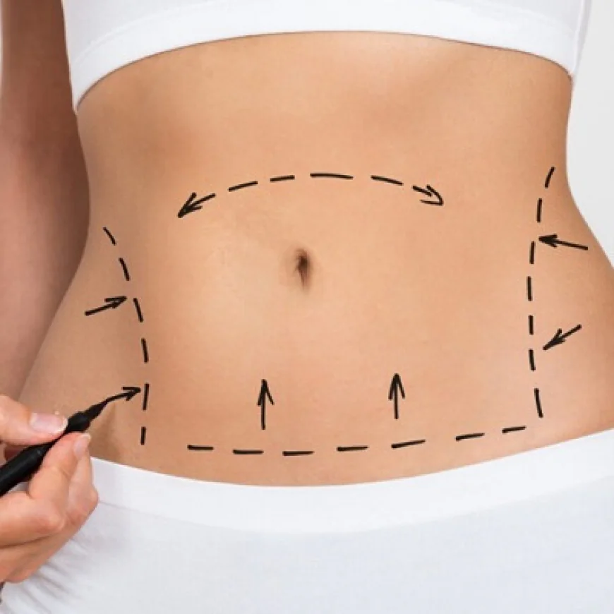 شد البطن لعلاج ترهل الجلد في منطقة البطن