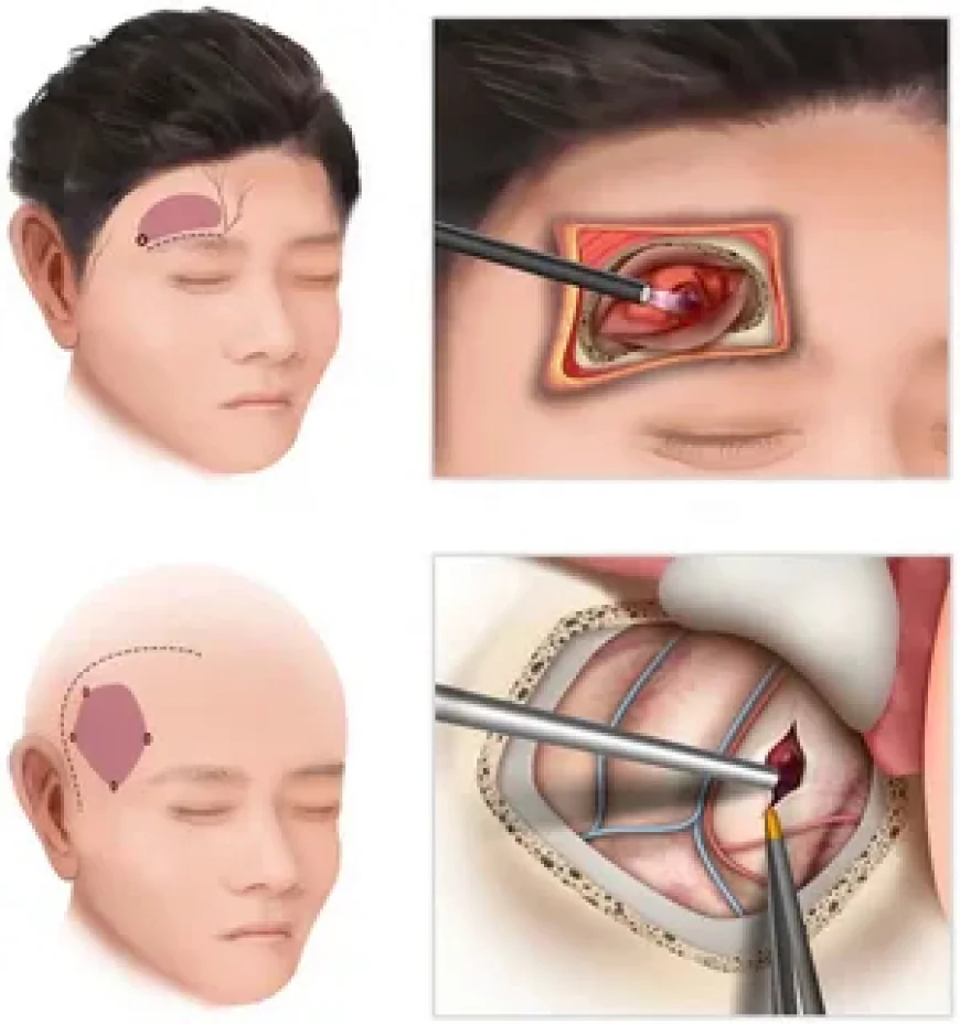 إزالة الورم الدموي في الرياض