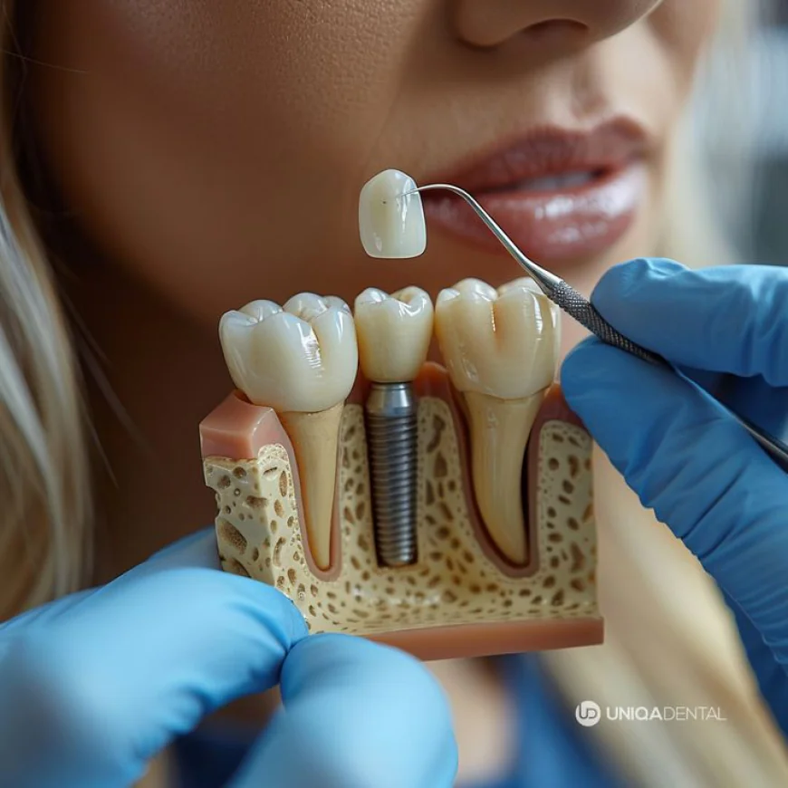 Dental Implant in Islamabad: Restore Your Smile with Modern Dentistry