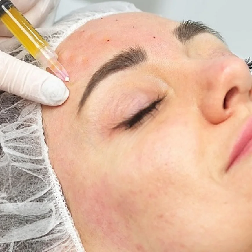 Over-the-Counter Acne Treatment Solutions