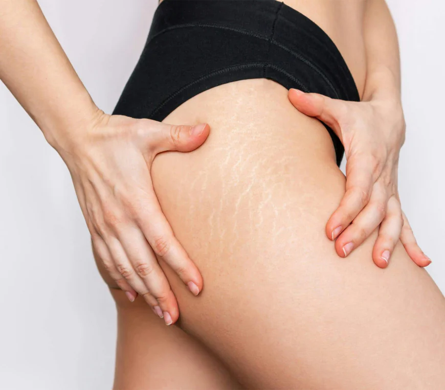 How Stretch Marks Removal Targets Dermal Tissue?