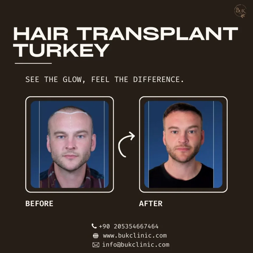 Hair Transplant Turkey: Safe and Advanced Solutions for Hair Restoration