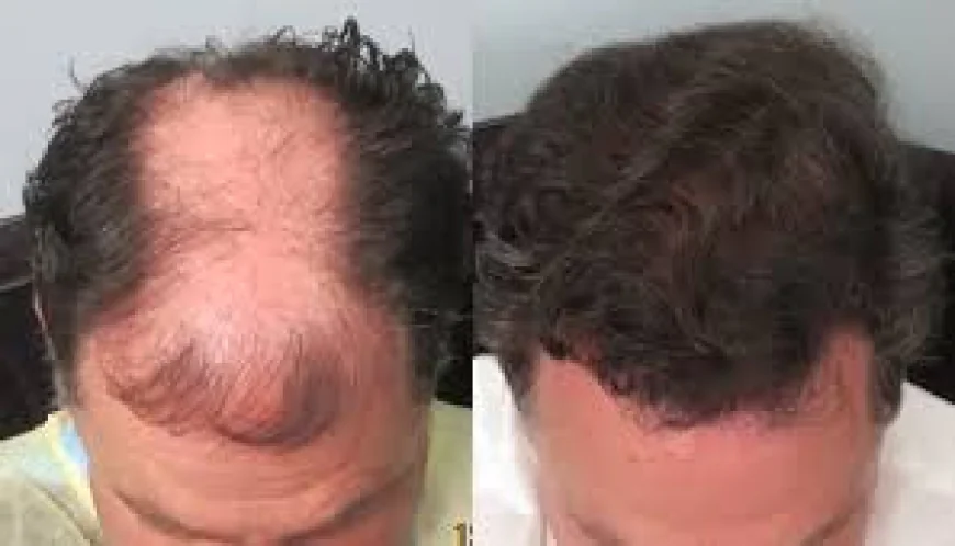 Hair Transplant in Santa Monica: Modern Approaches to Natural Hair Restoration