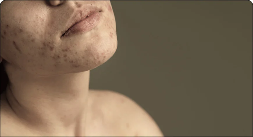 How to Prevent Acne Scars with Early Treatment