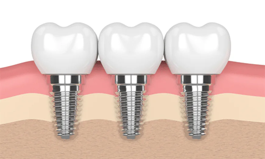 Transform Your Smile with Confidence: Expert Dental Implants & Braces in Houston